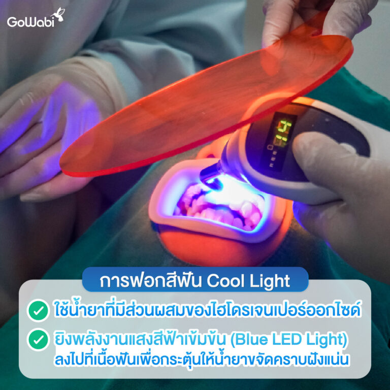 ฟอกสีฟันระบบ cool light รีวิวที่ zenitoni ระหว่างฟอกสีฟัน