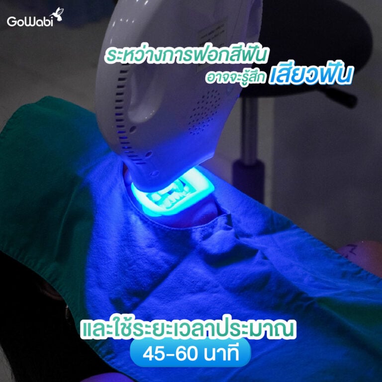 ฟอกสีฟันระบบ cool light รีวิวที่ zenitoni ระหว่างทำการฟอกสีฟัน