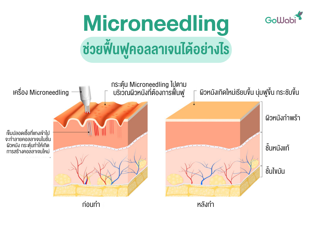 microneedling ทำงานอย่างไร